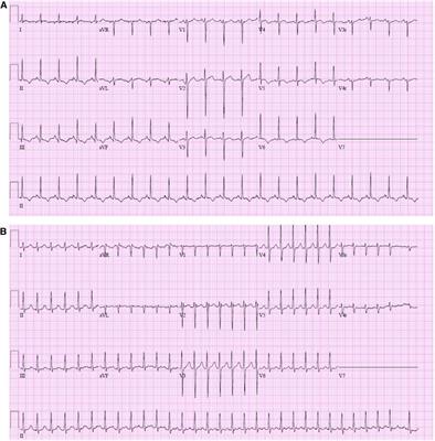 Atrial arrhythmias following lung transplant: a single pediatric center experience